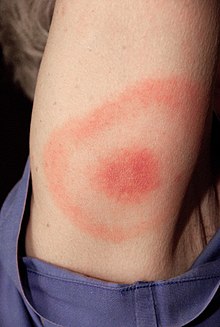 220px-Erythema_migrans_-_erythematous_rash_in_Lyme_disease_-_PHIL_9875.jpg